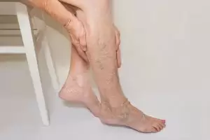 أسباب دوالي الساقين عند النساء