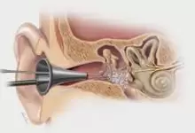 هل عملية ترقيع طبلة الأذن خطيرة