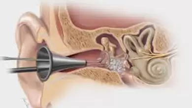 هل عملية ترقيع طبلة الأذن خطيرة