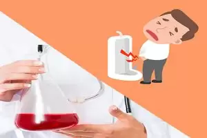 أعراض حصوات المثانة