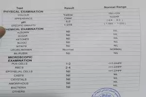 قراءة نتائج تحليل البول بالتفصيل