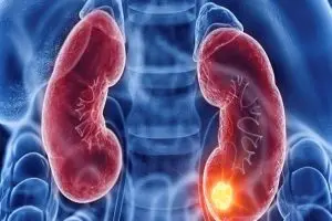 ما هي مراحل سرطان الكلى؟