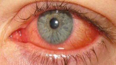 أعراض التهاب العين الفيروسي