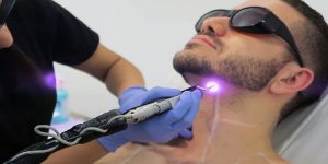 الليزر لازالة الشعر