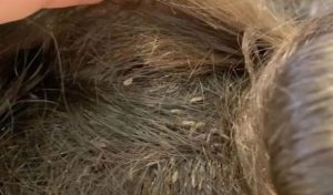 رؤية القمل في المنام