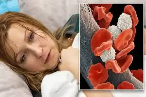 سرطان الدم 3 أنواع ما هي الاعراض والأسباب وطرق العلاج؟