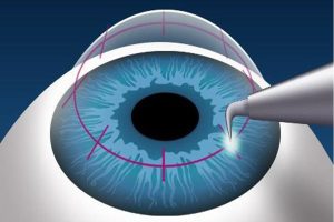 عملية زراعة القرنية بالتفصيل