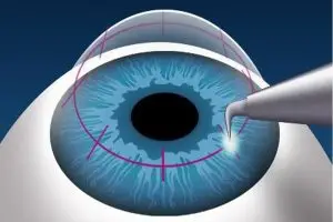 عملية زراعة القرنية بالتفصيل