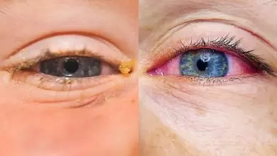 ما الفرق بين التهاب العين الفيروسي والبكتيري؟
