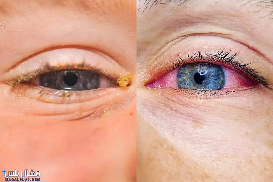 ما الفرق بين التهاب العين الفيروسي والبكتيري؟
