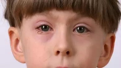 ما هي أسباب احمرار العين عند الأطفال؟
