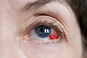 ما هي أسباب ارتفاع ضغط العين؟