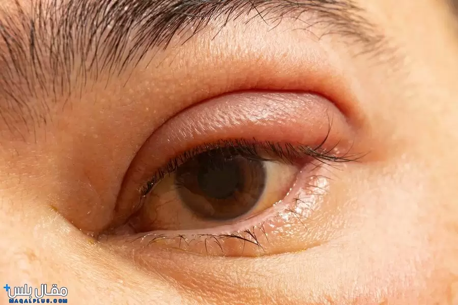 ما هي أسباب تورم جفن العين؟