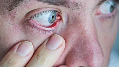 ما هي أعراض جفاف العين؟