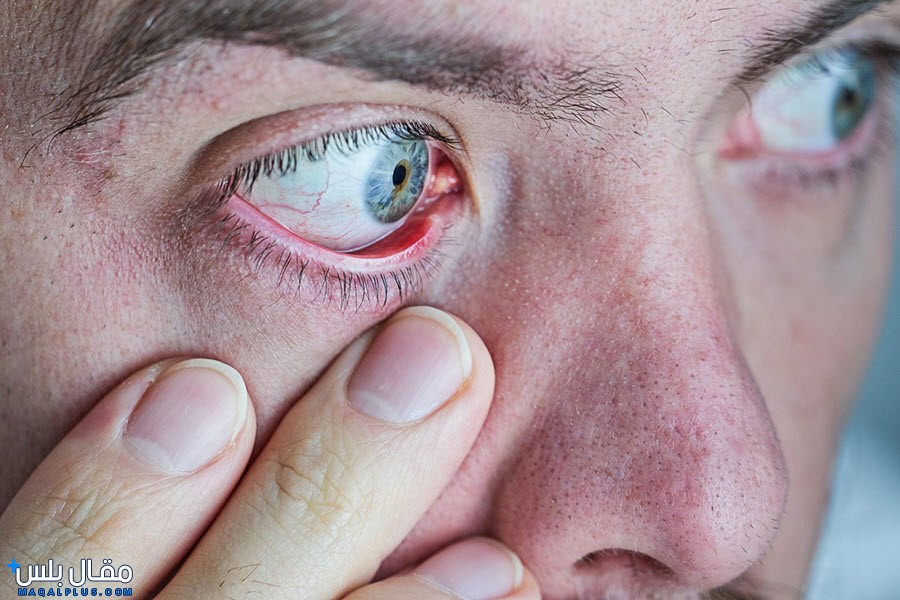 ما هي أعراض جفاف العين؟