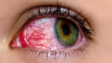 ما هي أمراض العيون واعراضها؟