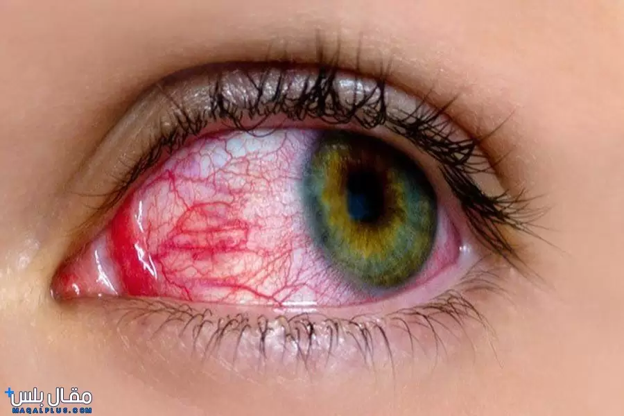 ما هي أمراض العيون واعراضها؟