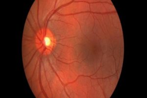 هل يشفى مريض التهاب العصب البصري؟