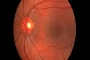 هل يشفى مريض التهاب العصب البصري؟