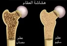 ما هو مرض هشاشة العظام ؟