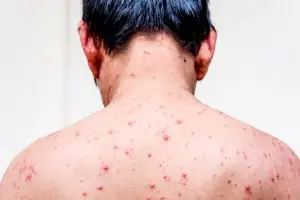 ما هي اعراض الايدز الاكيده في مراحل الإصابة المختلفة بالمرض؟