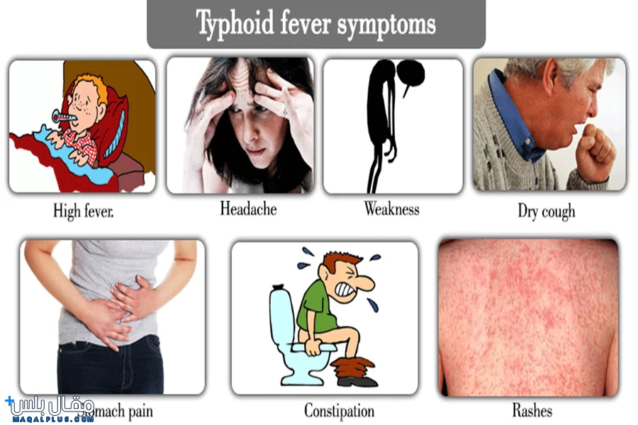 ما هي اعراض حمى التيفود؟