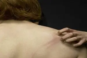 ما هي اعراض مرض الايدز الاولية في المراحل المبكرة؟