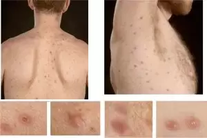 مرض الزهري Syphilis كيف ينتقل وما هي الأعراض وطرق العلاج