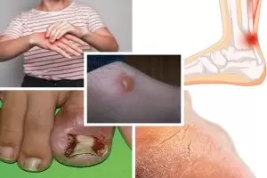 اعراض القدم السكرى بالتفصيل