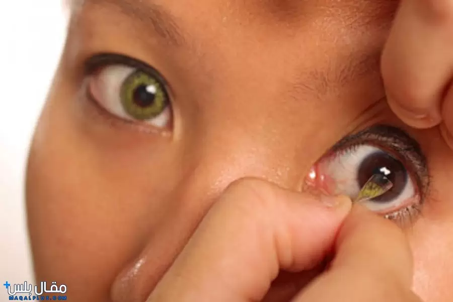 علاج احمرار العين من العدسات في المنزل