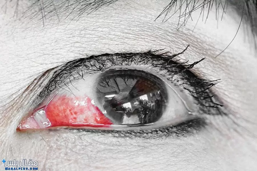 علاج انسداد الاوعية الدموية في العين