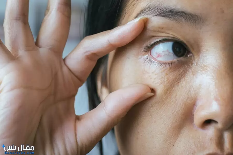 علاج جلطة العين بالتفصيل