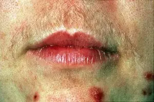 اعراض اضطراب هرمونات المبيض عند النساء