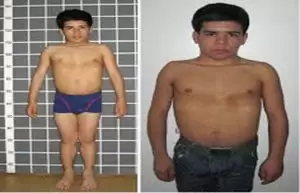 اعراض نقص هرمون النمو عند الأطفال