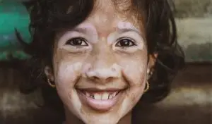 البهاق في المنام