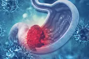 كم يعيش مريض سرطان المعدة بعد تشخيصه؟