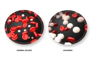 متى يجب إجراء تحليل سرطان الدم ؟