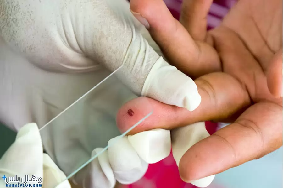 أنواع تحليل الملاريا في الدم