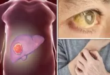 اعراض اورام الكبد بالتفصيل