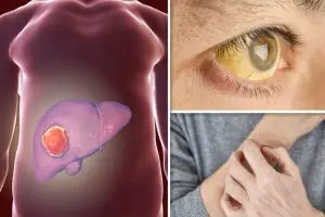 اعراض اورام الكبد بالتفصيل