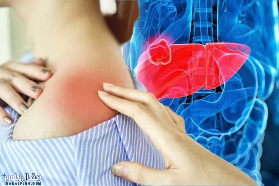 اعراض سرطان الكبد بالتفصيل