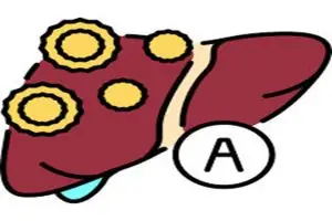 التهاب الكبد الوبائي أ بالتفصيل