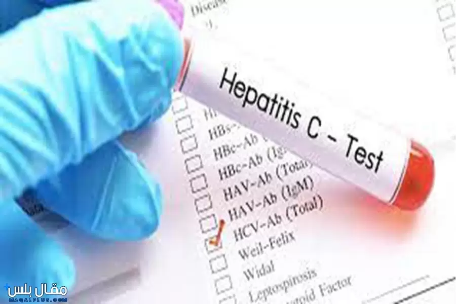 تحليل فيروس سي HCV