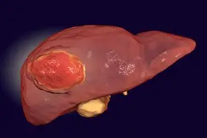 مراحل سرطان الكبد