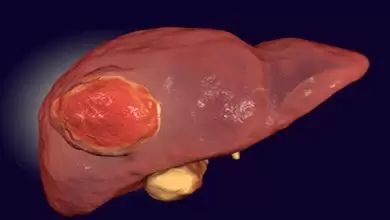 مراحل سرطان الكبد
