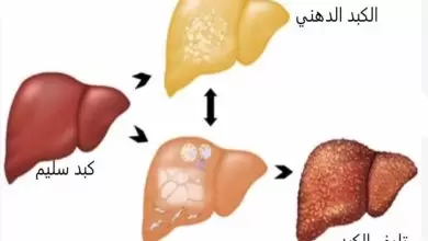 مراحل مرض الكبد الدهني
