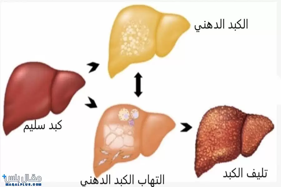 مراحل مرض الكبد الدهني