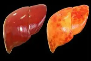 مرض الكبد الدهني غير الكحولي