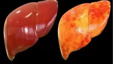 مرض الكبد الدهني غير الكحولي