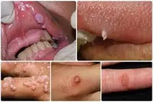 أعراض فيروس الورم الحليمي البشري HPV عند النساء والرجال